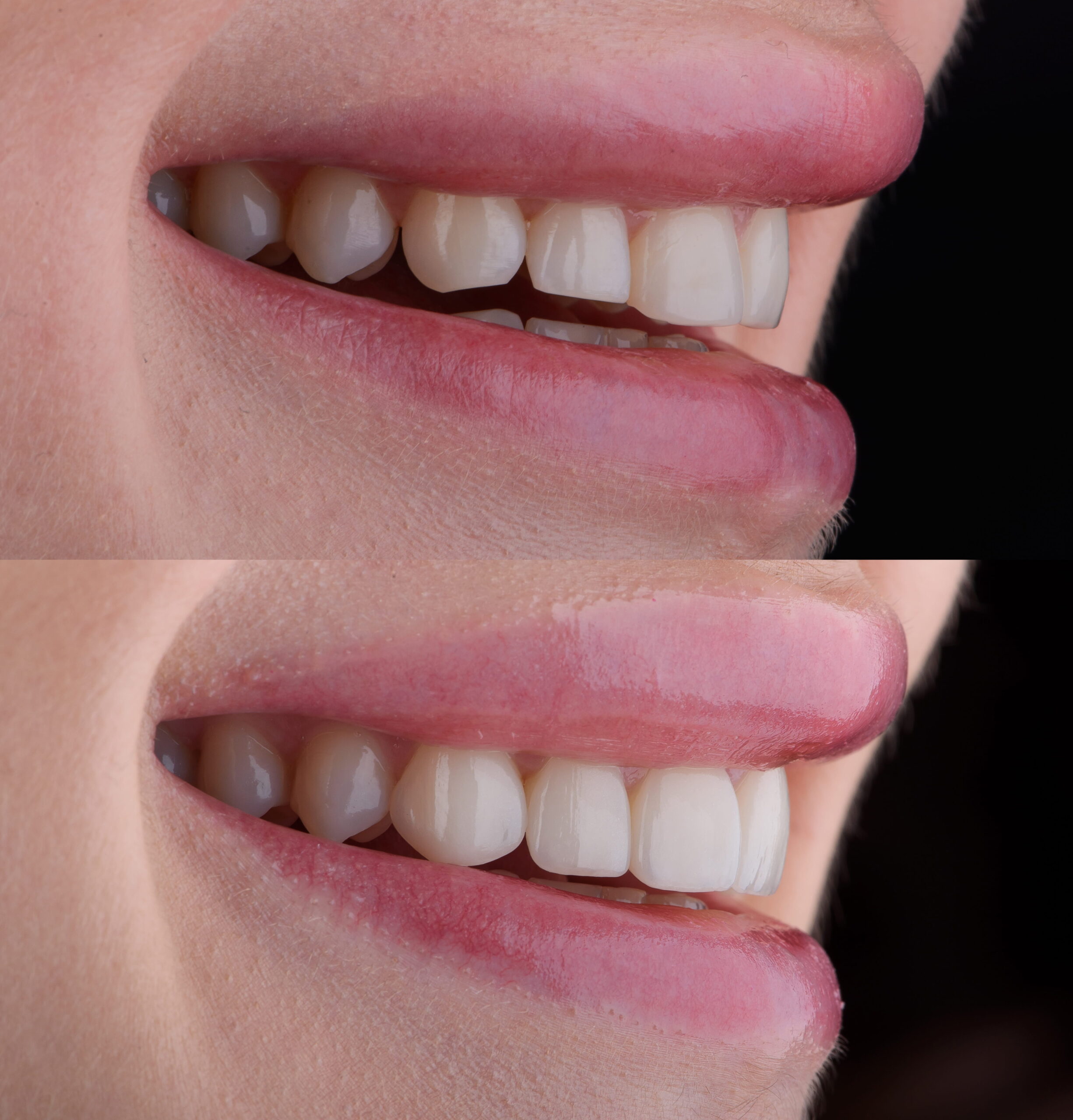 Smile Makeovers